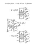 SPINAL TISSUE DISTRACTION DEVICES diagram and image