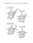 SPINAL TISSUE DISTRACTION DEVICES diagram and image