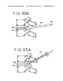 SPINAL TISSUE DISTRACTION DEVICES diagram and image