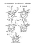 SPINAL TISSUE DISTRACTION DEVICES diagram and image