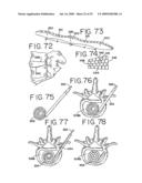 SPINAL TISSUE DISTRACTION DEVICES diagram and image