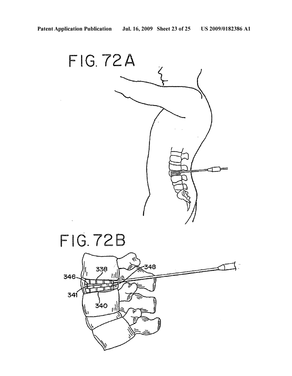 SPINAL TISSUE DISTRACTION DEVICES - diagram, schematic, and image 24