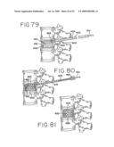SPINAL TISSUE DISTRACTION DEVICES diagram and image