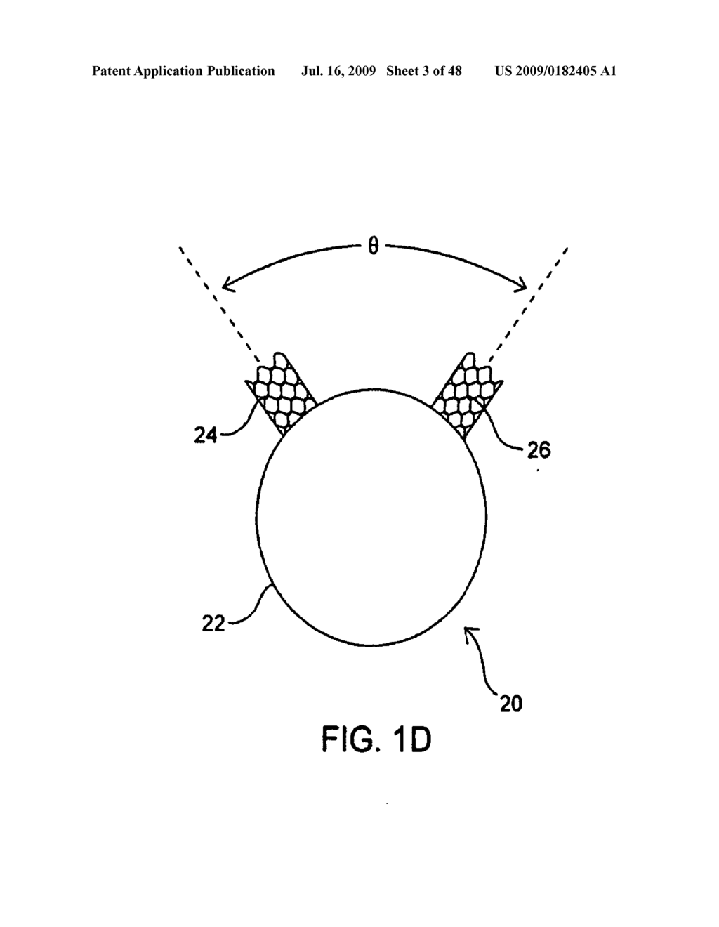 APPARATUS AND METHOD FOR DEPLOYING AN IMPLANTABLE DEVICE WITHIN THE BODY - diagram, schematic, and image 04