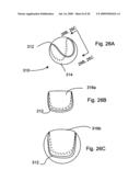 Bioerodible self-deployable intragastric implants diagram and image