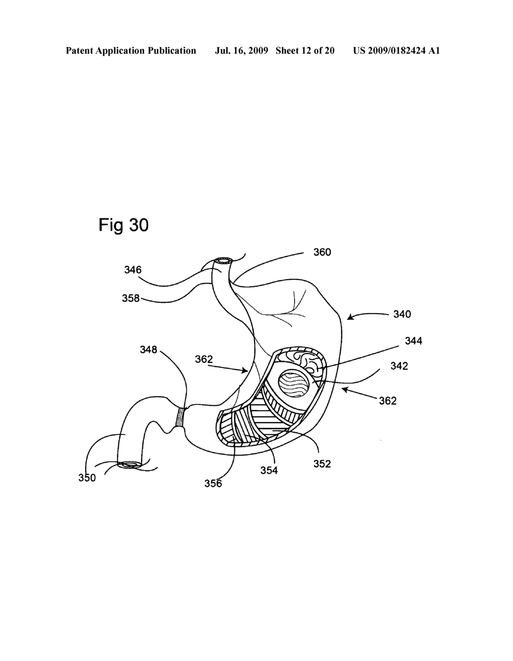 Bioerodible self-deployable intragastric implants - diagram, schematic, and image 13