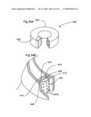 Bioerodible self-deployable intragastric implants diagram and image