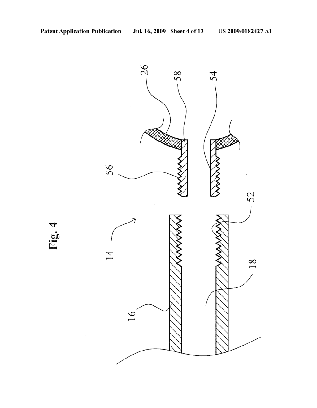 VERTEBROPLASTY IMPLANT WITH ENHANCED INTERFACIAL SHEAR STRENGTH - diagram, schematic, and image 05