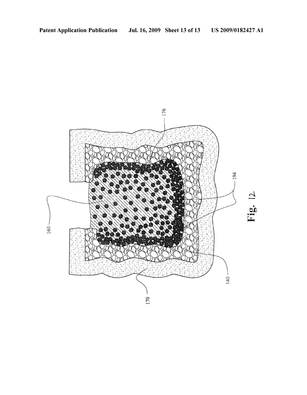 VERTEBROPLASTY IMPLANT WITH ENHANCED INTERFACIAL SHEAR STRENGTH - diagram, schematic, and image 14