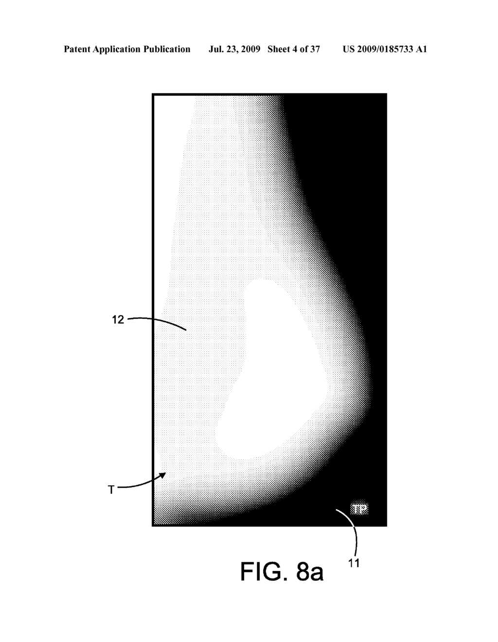 Method and Apparatus for Processing Digital Mammographic Images - diagram, schematic, and image 05