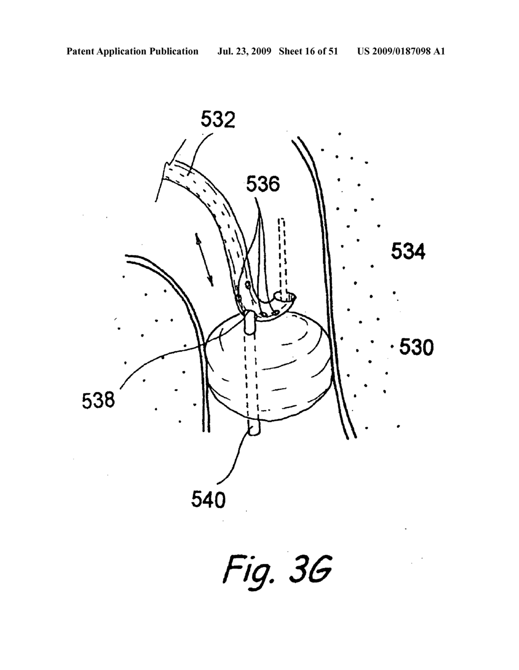 Devices, Systems and Methods for Diagnosing and Treating Sinusitis and Other Disorders of the Ears, Nose, and/or Throat - diagram, schematic, and image 17