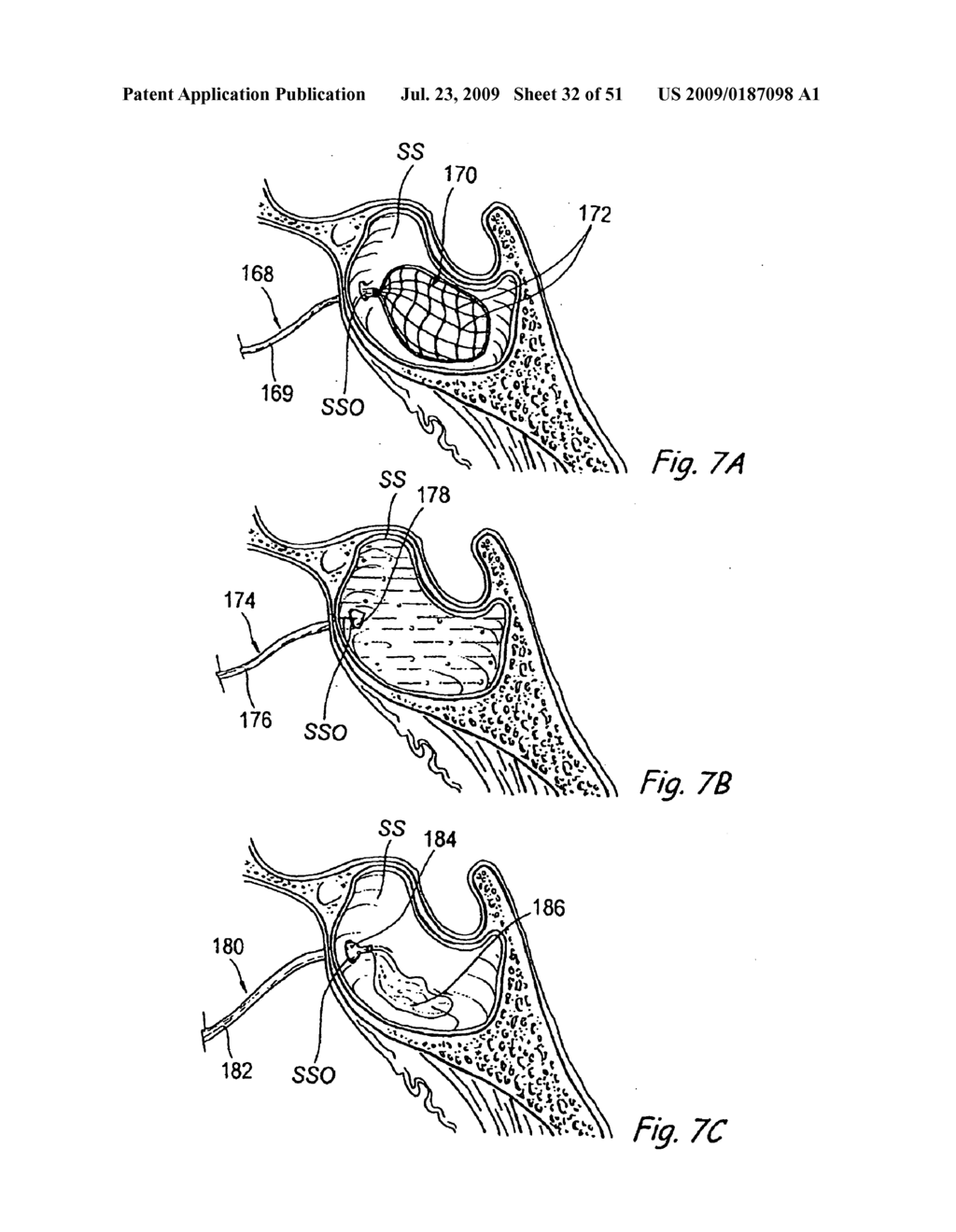 Devices, Systems and Methods for Diagnosing and Treating Sinusitis and Other Disorders of the Ears, Nose, and/or Throat - diagram, schematic, and image 33