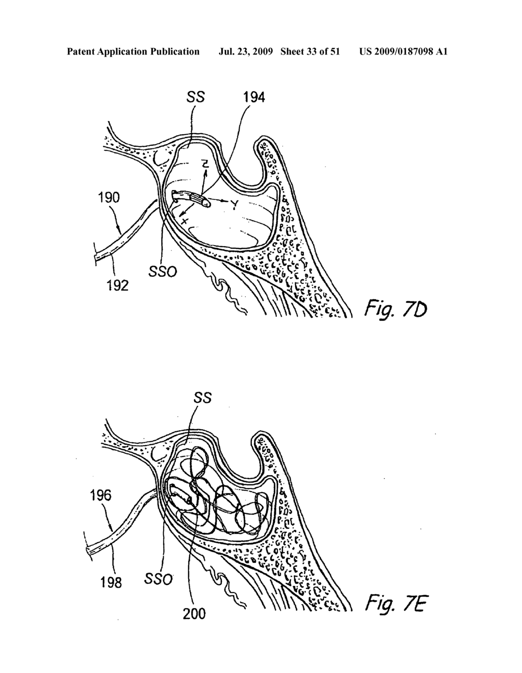 Devices, Systems and Methods for Diagnosing and Treating Sinusitis and Other Disorders of the Ears, Nose, and/or Throat - diagram, schematic, and image 34