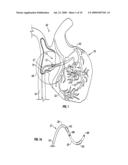 METHOD AND APPARATUS TO REMOVE SUBSTANCES FROM VESSELS OF THE HEART AND OTHER PARTS OF THE BODY TO MINIMIZE OR AVOID RENAL OR OTHER HARM OR DYSFUNCTION diagram and image