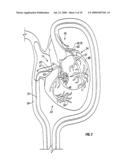 METHOD AND APPARATUS TO REMOVE SUBSTANCES FROM VESSELS OF THE HEART AND OTHER PARTS OF THE BODY TO MINIMIZE OR AVOID RENAL OR OTHER HARM OR DYSFUNCTION diagram and image