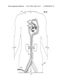 METHOD AND APPARATUS TO REMOVE SUBSTANCES FROM VESSELS OF THE HEART AND OTHER PARTS OF THE BODY TO MINIMIZE OR AVOID RENAL OR OTHER HARM OR DYSFUNCTION diagram and image