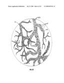 METHOD AND APPARATUS TO REMOVE SUBSTANCES FROM VESSELS OF THE HEART AND OTHER PARTS OF THE BODY TO MINIMIZE OR AVOID RENAL OR OTHER HARM OR DYSFUNCTION diagram and image