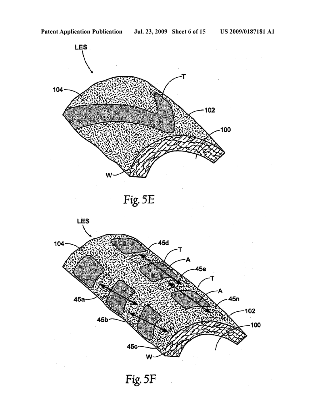 SURGICAL INSTRUMENTS AND TECHNIQUES FOR TREATING GASTRO-ESOPHAGEAL REFLUX DISEASE - diagram, schematic, and image 07