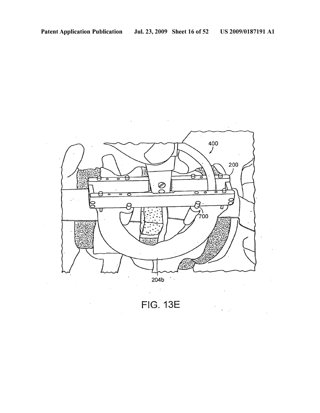 Systems, Devices and Apparatuses for Bony Fixation and Disk Repair and Replacement and Methods Related Thereto - diagram, schematic, and image 17