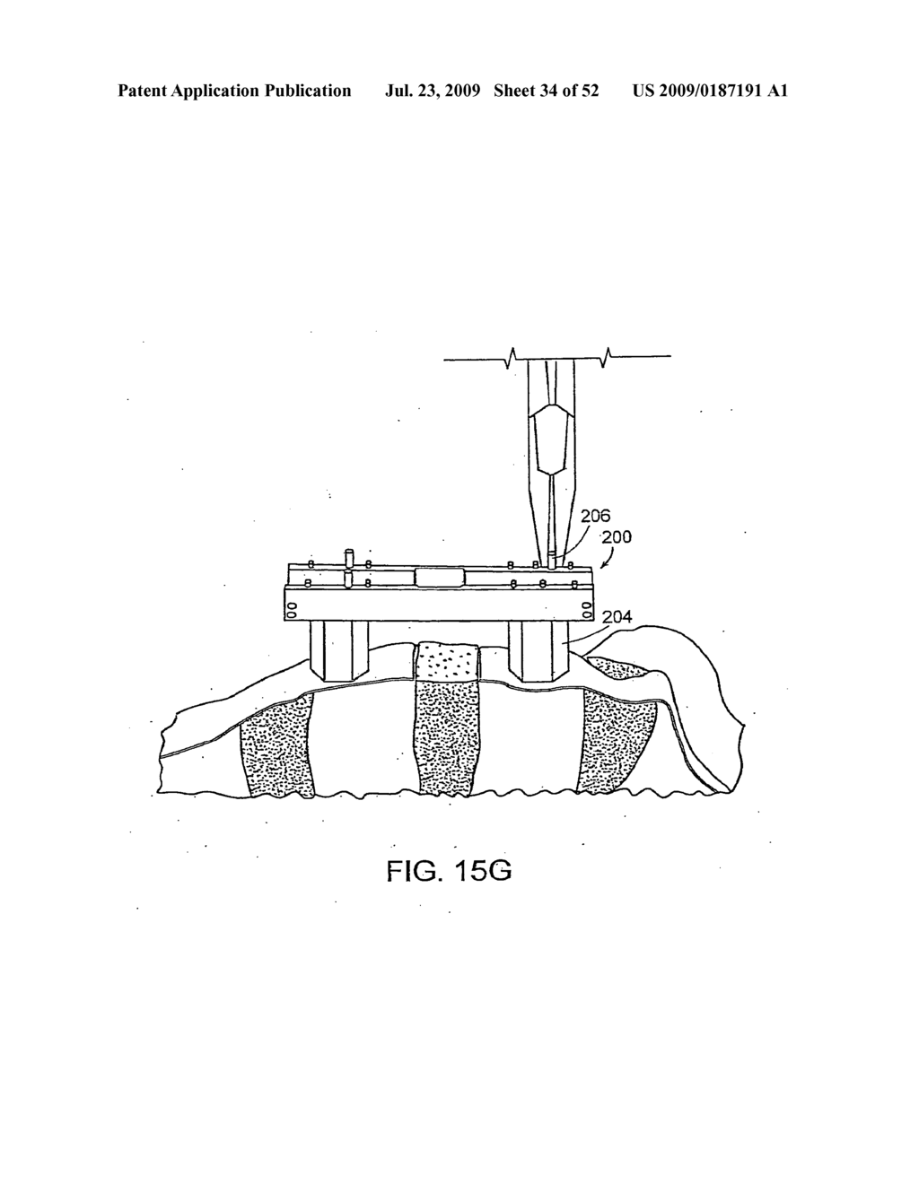 Systems, Devices and Apparatuses for Bony Fixation and Disk Repair and Replacement and Methods Related Thereto - diagram, schematic, and image 35