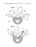 One step entry pedicular preparation device and disc access system diagram and image