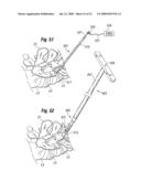 One step entry pedicular preparation device and disc access system diagram and image