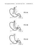 GASTRIC RETAINING DEVICES AND METHODS diagram and image