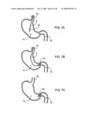 GASTRIC RETAINING DEVICES AND METHODS diagram and image