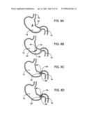 GASTRIC RETAINING DEVICES AND METHODS diagram and image