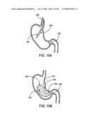 GASTRIC RETAINING DEVICES AND METHODS diagram and image