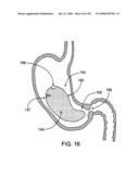 GASTRIC RETAINING DEVICES AND METHODS diagram and image