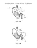 GASTRIC RETAINING DEVICES AND METHODS diagram and image