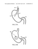 GASTRIC RETAINING DEVICES AND METHODS diagram and image