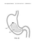 GASTRIC RETAINING DEVICES AND METHODS diagram and image