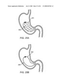 GASTRIC RETAINING DEVICES AND METHODS diagram and image