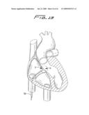 Vascular hole closure device diagram and image