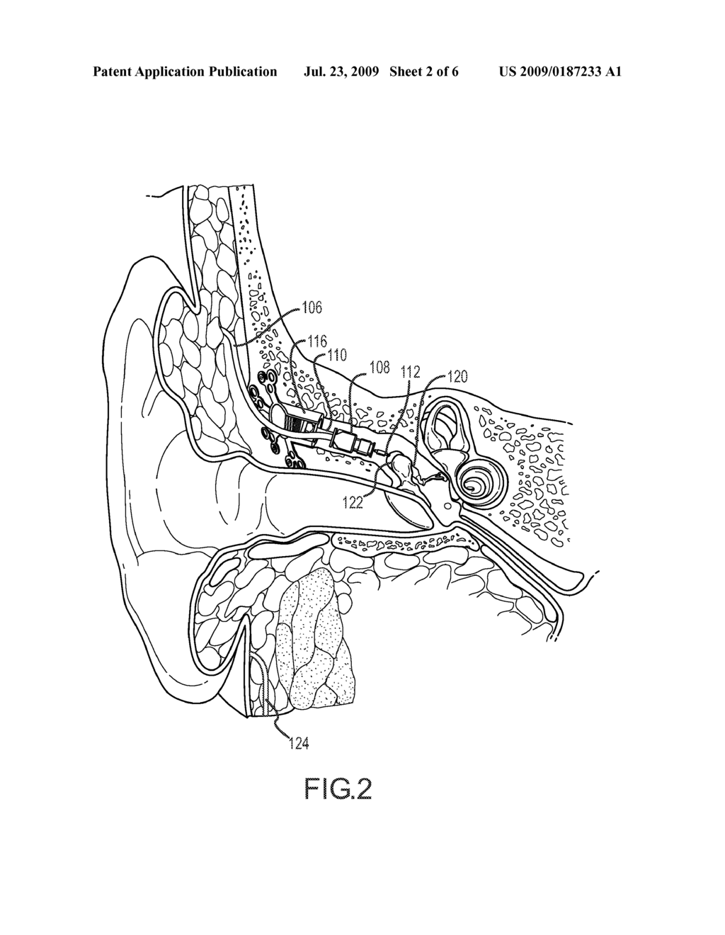 CONNECTOR FOR IMPLANTABLE HEARING AID - diagram, schematic, and image 03