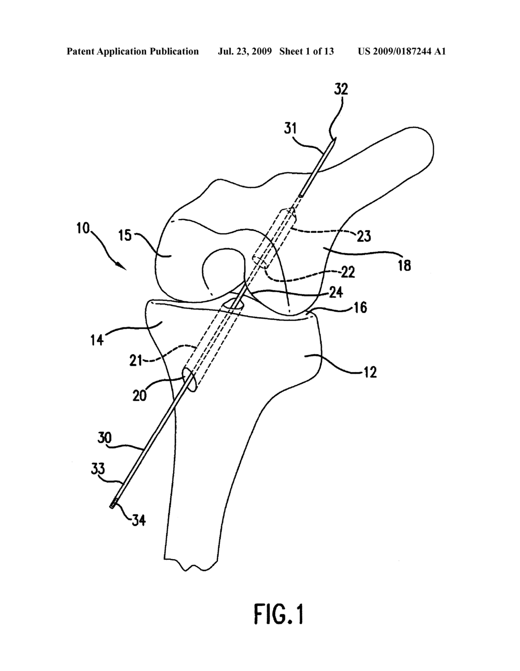 METHOD OF ARTHROSCOPICALLY ASSISTED LIGAMENT RECONSTRUCTION - diagram, schematic, and image 02