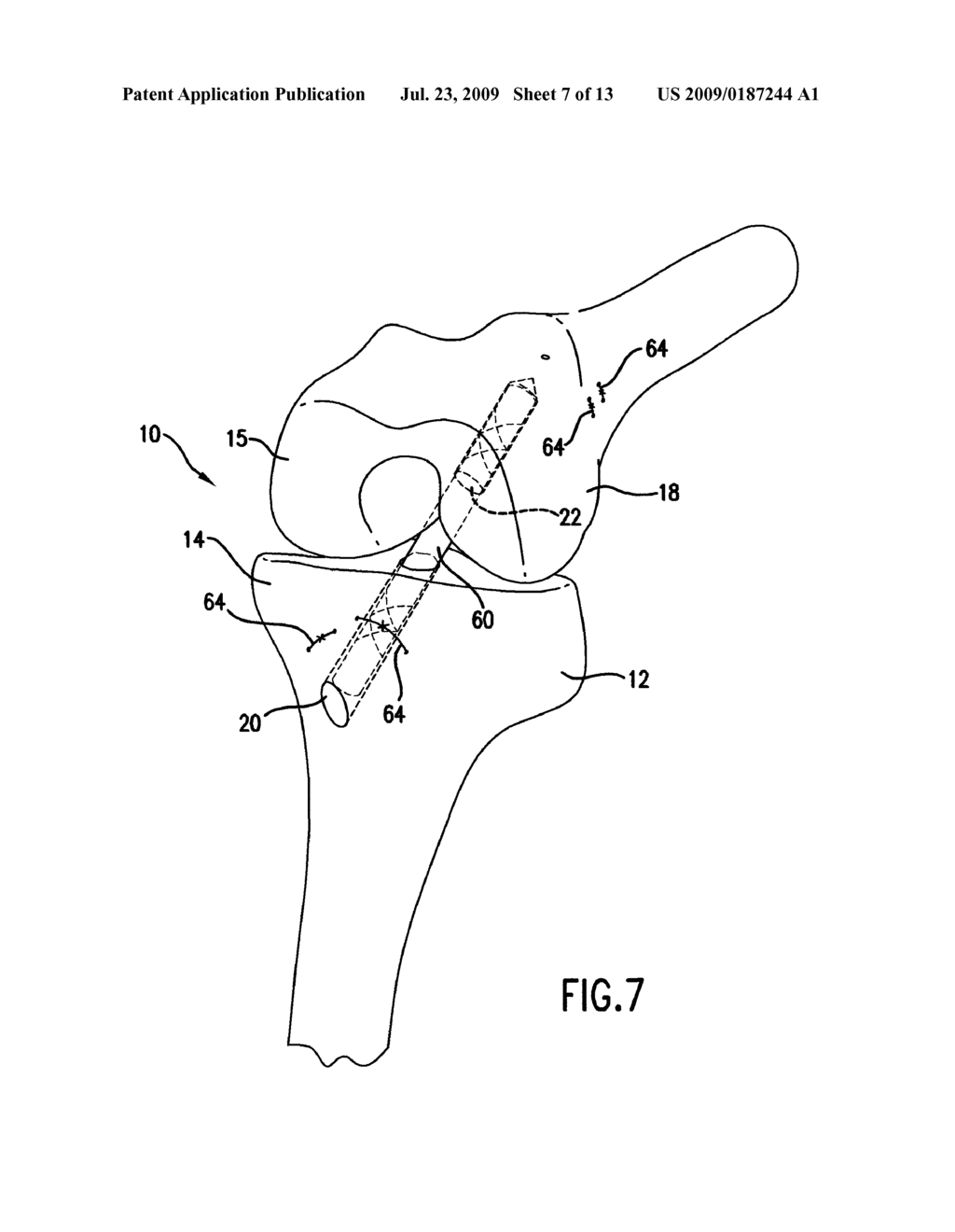 METHOD OF ARTHROSCOPICALLY ASSISTED LIGAMENT RECONSTRUCTION - diagram, schematic, and image 08