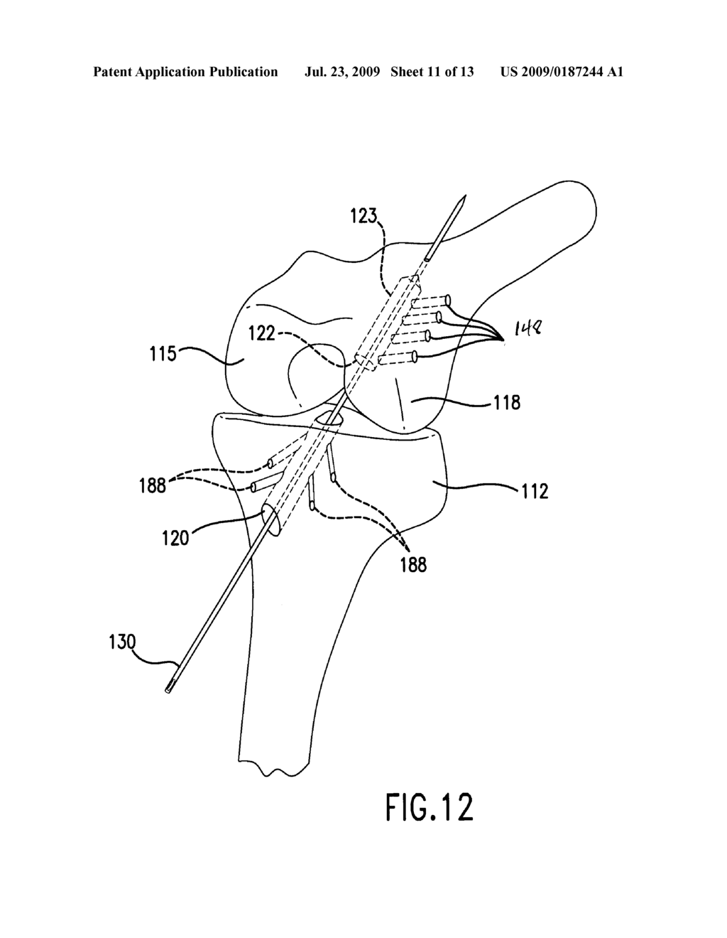 METHOD OF ARTHROSCOPICALLY ASSISTED LIGAMENT RECONSTRUCTION - diagram, schematic, and image 12