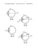 DUAL SCHEIMPFLUG SYSTEM FOR THREE-DIMENSIONAL ANALYSIS OF AN EYE diagram and image