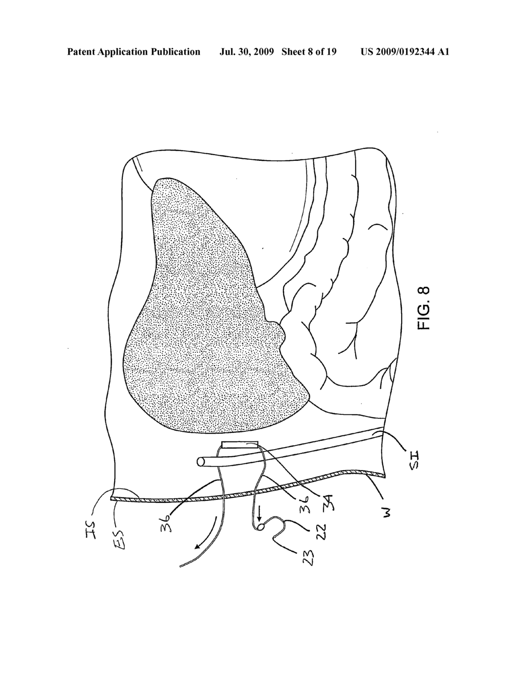 SURGICAL DEVICES FOR MANIPULATING TISSUE - diagram, schematic, and image 09