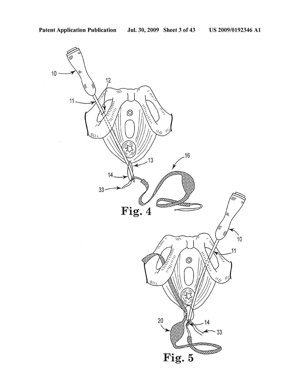 TREATMENT OF ANAL INCONTINENCE AND DEFECATORY DYSFUNCTION - diagram, schematic, and image 04