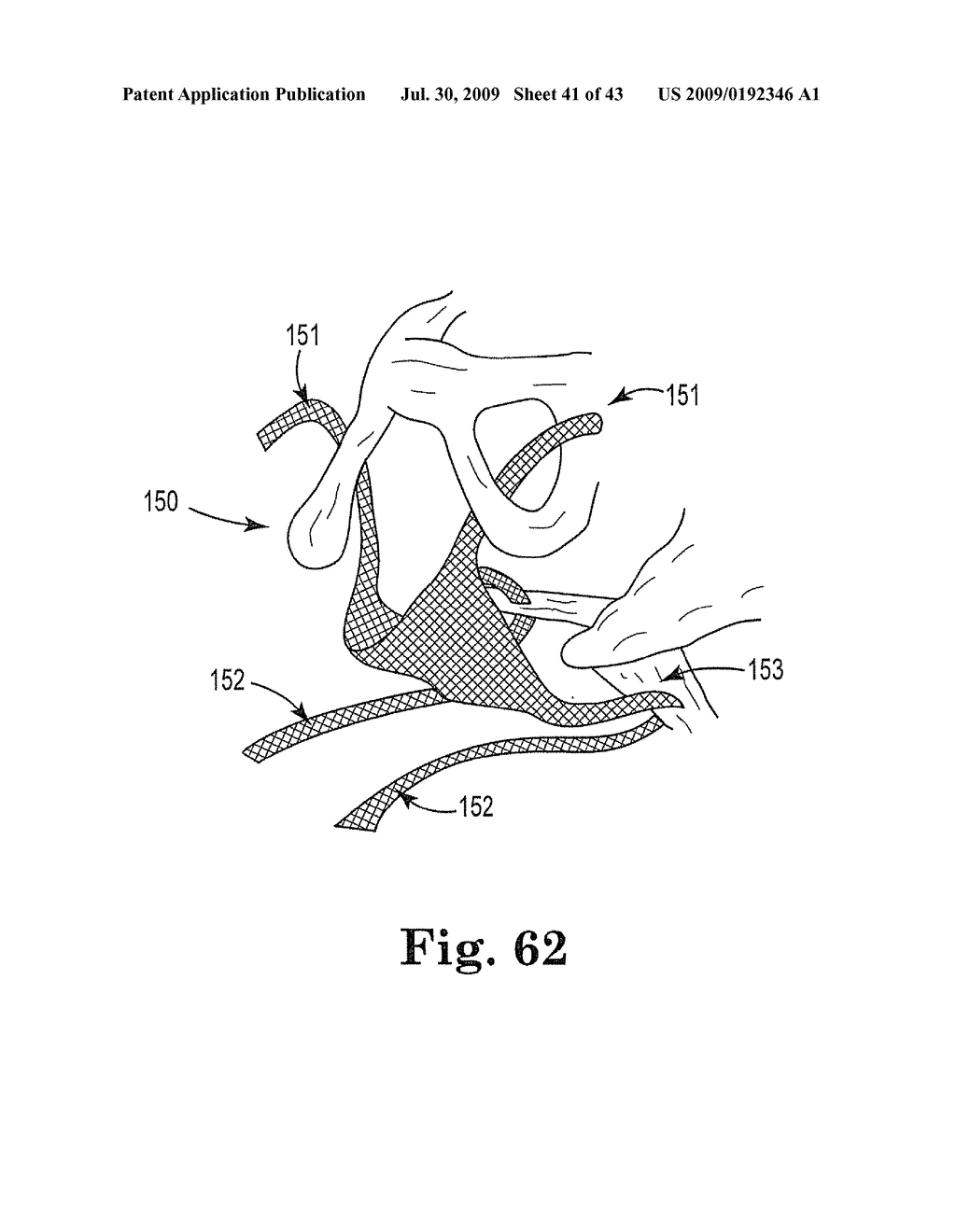 TREATMENT OF ANAL INCONTINENCE AND DEFECATORY DYSFUNCTION - diagram, schematic, and image 42