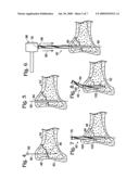 BONE NAIL diagram and image