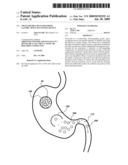 Swallowable Self-Expanding Gastric Space Occupying Device diagram and image