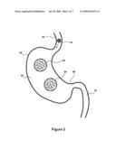Swallowable Self-Expanding Gastric Space Occupying Device diagram and image