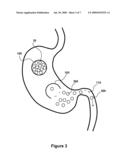 Swallowable Self-Expanding Gastric Space Occupying Device diagram and image