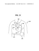 METHODS AND DEVICES FOR PREDICTING PERFORMANCE OF A GASTRIC RESTRICTION SYSTEM diagram and image