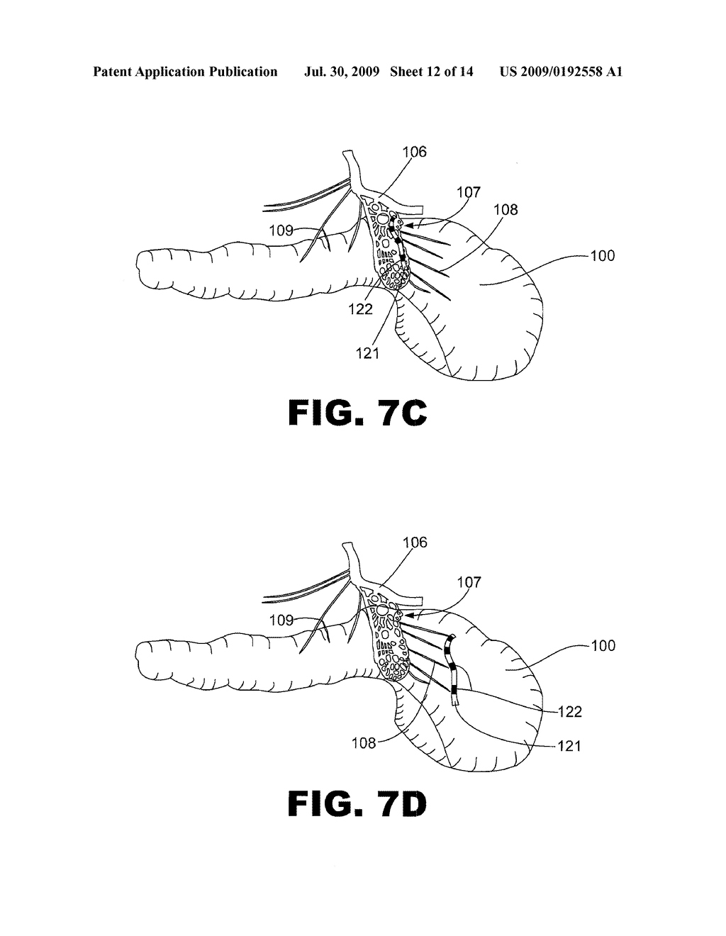 METHODS AND SYSTEMS OF TREATING PANCREATITIS PAIN - diagram, schematic, and image 13